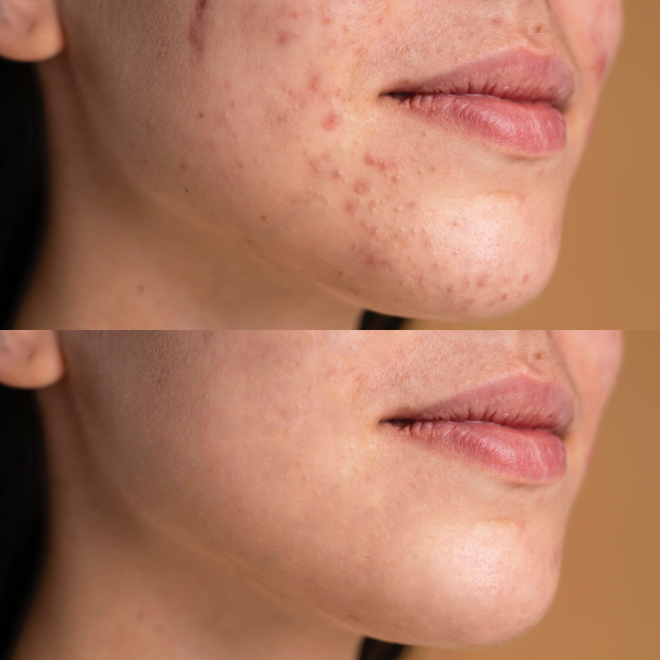 Портативний дарсонваль MEDICA+ DARSOLINE 7.0 Сase (Japan)